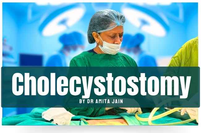 Gallbladder Drainage Cholecystostomy